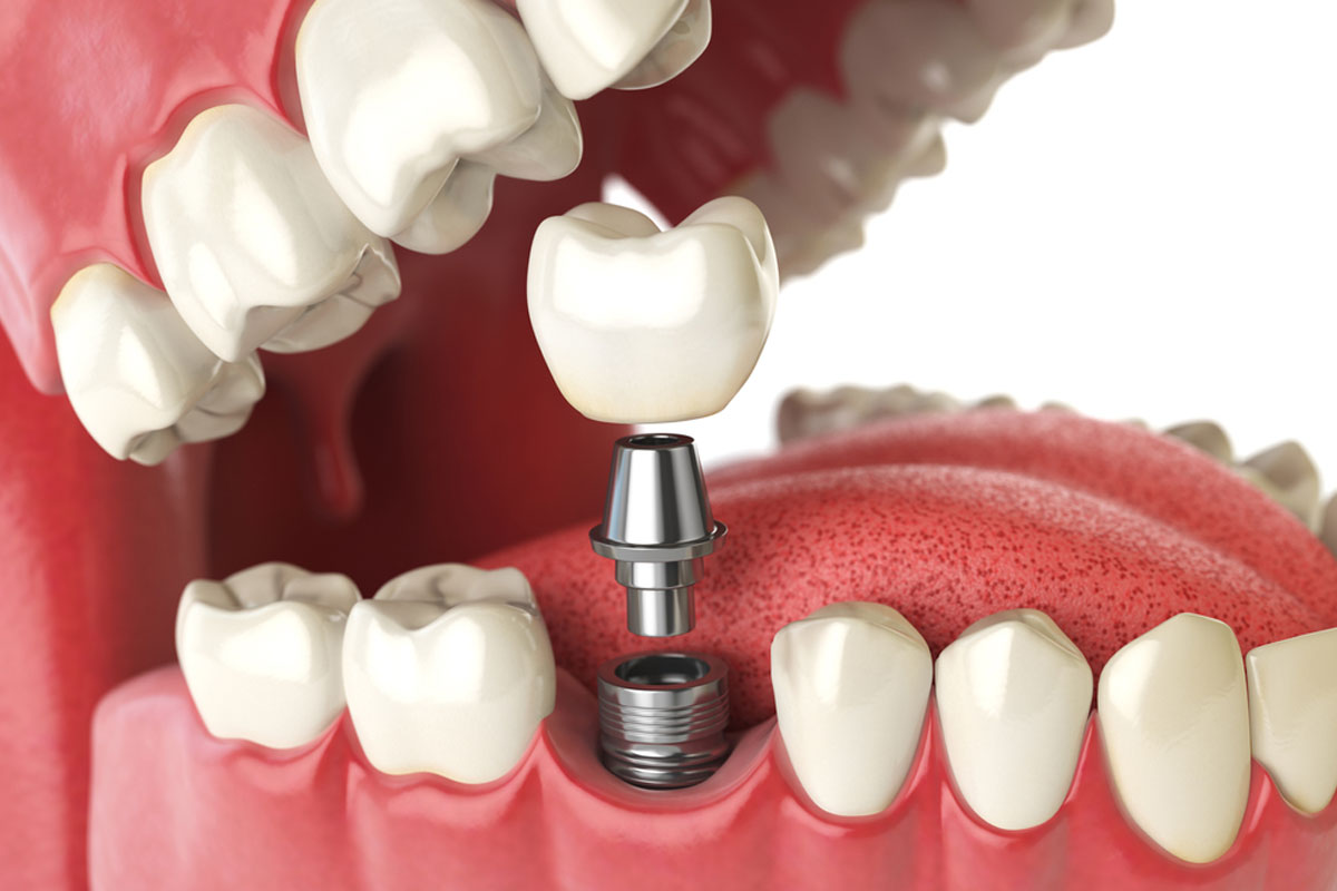 Best Dental Implant in Jaipur | Dental Trendz